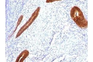 Formalin-fixed, paraffin-embedded human endometrial carcinoma stained with Cytokeratin 7 antibody (KRT7/760) (Cytokeratin 7 anticorps)