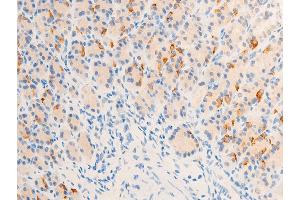 ABIN6267284 at 1/100 staining rat gastric cancer tissue sections by IHC-P.