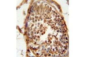 Formalin fixed and paraffin embedded human testis carcinoma reacted with DNAJB13 Antibody (Center) followed by peroxidase conjugation of the secondary antibody and DAB staining. (DNAJB13 anticorps  (Middle Region))