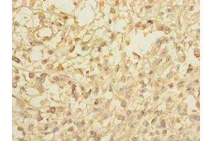 Immunohistochemistry of paraffin-embedded human melanoma using ABIN7148072 at dilution of 1:100 (CCDC113 anticorps  (AA 1-200))