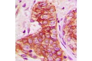 Immunohistochemical analysis of Connexin 43 staining in human breast cancer formalin fixed paraffin embedded tissue section.