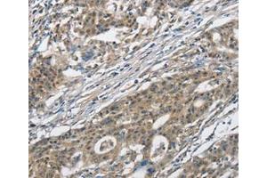 Immunohistochemical analysis of paraffin-embedded Human gastric cancer tissue using at dilution 1/30. (CACNA2D1 anticorps  (Internal Region))