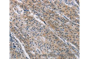 Immunohistochemistry of Human gastric cancer using BMP15 Polyclonal Antibody at dilution of 1:40 (BMP15 anticorps)