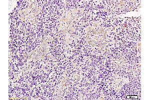Formalin-fixed and paraffin embedded human glioma tissue labeled with Anti-JUP/Cateninma ? (JUP anticorps  (AA 601-700))