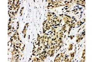 IHC-P: MCM7 antibody testing of human lung cancer tissue (MCM7 anticorps  (C-Term))