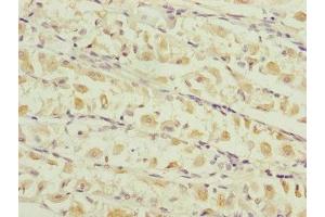 Immunohistochemistry of paraffin-embedded human gastric cancer using ABIN7159903 at dilution of 1:100 (TIMM17B anticorps  (AA 1-172))