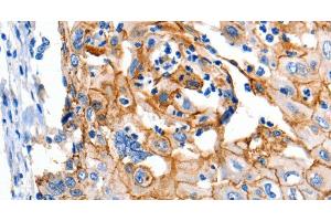 Immunohistochemistry of paraffin-embedded Human cervical cancer using Claudin 1 Polyclonal Antibody at dilution of 1:150 (Claudin 1 anticorps)