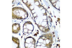 Immunohistochemistry of paraffin-embedded human colon carcinoma using SECISBP2 antibody at dilution of 1:200 (40x lens). (SECISBP2 anticorps)