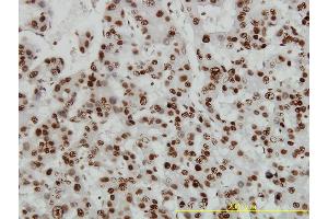 Immunoperoxidase of monoclonal antibody to HMGB1 on formalin-fixed paraffin-embedded human hepatocellular carcinoma tissue. (HMGB1 anticorps  (AA 1-215))