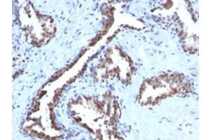 Immunohistochemical staining (Formalin-fixed paraffin-embedded sections) of human prostate carcinoma with CCNB1 monoclonal antibody, clone CCNB1/1098 . (Cyclin B1 anticorps)