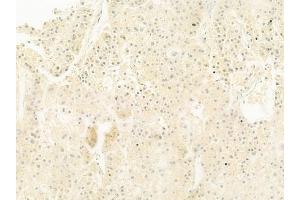 ABIN6261829 and ABIN6278464 at 1/100 staining human hepatocellular carcinoma by IHC-P. (CD15 anticorps  (N-Term))