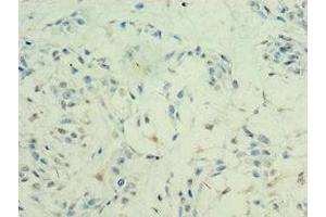 Immunohistochemistry of paraffin-embedded human breast cancer using ABIN7155309 at dilution of 1:100