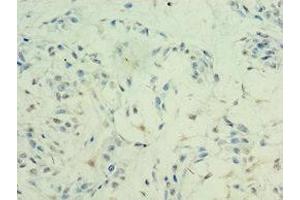 Immunohistochemistry of paraffin-embedded human breast cancer using ABIN7155309 at dilution of 1:100 (HDAC11 anticorps  (AA 1-347))