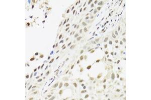 Immunohistochemistry of paraffin-embedded human lung cancer using C14orf166 antibody. (C14orf166 anticorps)