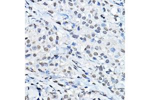 Immunohistochemistry of paraffin-embedded human breast cancer using MonoMethyl-Histone H3-K27 Rabbit pAb (ABIN3023262, ABIN3023263, ABIN3023264, ABIN1513004 and ABIN6219518) at dilution of 1:100 (40x lens). (Histone 3 anticorps  (H3K27me1))