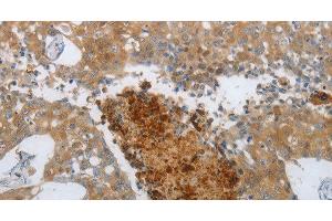 Immunohistochemistry of paraffin-embedded Human breast cancer using NGFR Polyclonal Antibody at dilution of 1:50 (NGFR anticorps)