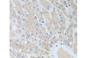 Immunohistochemistry of paraffin-embedded Human liver damage using DLK1 Polyclonal Antibody at dilution of 1:100 (40x lens). (DLK1 anticorps)