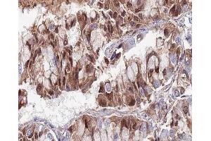 ABIN6266657 at 1/100 staining human lung carcinoma tissue sections by IHC-P.