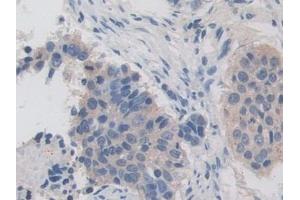 Detection of IREB2 in Human Lung cancer Tissue using Polyclonal Antibody to Iron Responsive Element Binding Protein 2 (IREB2)