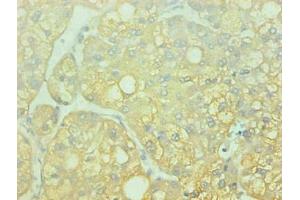 Immunohistochemical of paraffin-embedded human liver cancer using ABIN7143609 at dilution of 1:200 (Fetuin A anticorps)