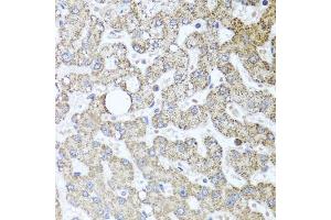 Immunohistochemistry of paraffin-embedded human liver injury using TSG101 antibody. (TSG101 anticorps)