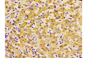 Immunohistochemistry of paraffin-embedded human liver cancer using ABIN7172602 at dilution of 1:100
