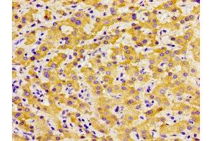 Immunohistochemistry of paraffin-embedded human liver cancer using ABIN7172602 at dilution of 1:100 (SOX11 anticorps  (AA 241-341))