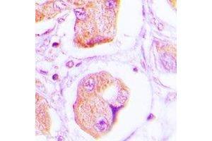 Immunohistochemical analysis of OLFM1 staining in human lung cancer formalin fixed paraffin embedded tissue section. (Olfactomedin 1 anticorps)