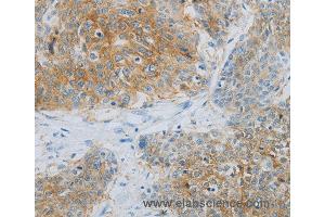 Immunohistochemistry of Human esophagus cancer using NDRG1 Polyclonal Antibody at dilution of 1:70 (NDRG1 anticorps)