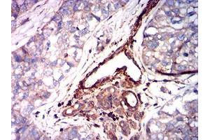 Immunohistochemical analysis of paraffin-embedded bladder cancer tissues using ACTA2 mouse mAb with DAB staining.