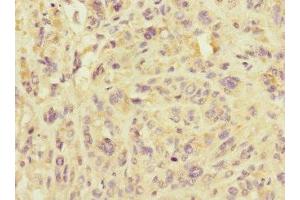 Immunohistochemistry of paraffin-embedded human melanoma using ABIN7159921 at dilution of 1:100