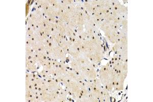 Immunohistochemistry of paraffin-embedded human gastric cancer using IRF2 antibody (ABIN3023366, ABIN3023367, ABIN3023368 and ABIN6219659) at dilution of 1:200 (40x lens). (IRF2 anticorps  (AA 120-349))