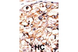 Formalin-fixed and paraffin-embedded human hepatocellular carcinoma tissue reacted with PGK2 polyclonal antibody  , which was peroxidase-conjugated to the secondary antibody, followed by AEC staining. (PGK2 anticorps  (N-Term))