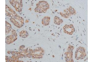 ABIN6268905 at 1/50 staining human breast cancer tissue sections by IHC-P. (OCT4 anticorps  (Internal Region))