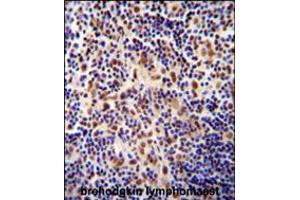 TIGD3 antibody immunohistochemistry analysis in formalin fixed and paraffin embedded human hodgkin lymphoma followed by peroxidase conjugation of the secondary antibody and DAB staining. (TIGD3 anticorps  (C-Term))
