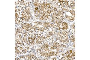 Immunohistochemistry of paraffin-embedded human liver cancer using S Rabbit mAb (ABIN7270501) at dilution of 1:250 (40x lens). (SAMM50 anticorps)