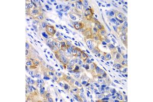 Immunohistochemistry of paraffin-embedded human gastric cancer using BCL2 antibody.