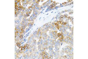 Immunohistochemistry of paraffin-embedded human liver cancer using STAT3 antibody (ABIN1876697) at dilution of 1:100 (40x lens). (STAT3 anticorps)