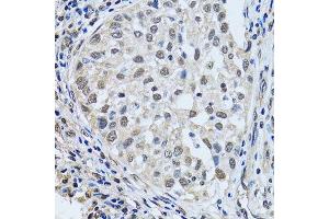 Immunohistochemistry of paraffin-embedded human lung cancer using LSM4 antibody.