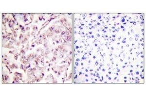 Immunohistochemical analysis of paraffin-embedded human breast carcinoma tissue, using ETS1 (Phospho-Thr38) antibody (left)or the same antibody preincubated with blocking peptide (right).