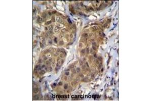 RNF11 Antibody (Center) (ABIN656832 and ABIN2846041) immunohistochemistry analysis in formalin fixed and paraffin embedded human breast carcinoma followed by peroxidase conjugation of the secondary antibody and DAB staining. (RNF11 anticorps  (AA 64-90))