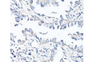 Immunohistochemistry of paraffin-embedded Human lung cancer using P Glycoprotein Polyclonal Antibody at dilution of 1:100 (40x lens). (P-Glycoprotein anticorps)