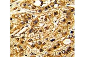 IHC analysis of FFPE human hepatocarcinoma stained with CD11c antibody