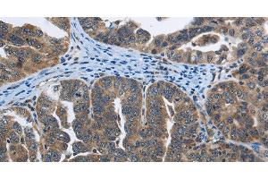Immunohistochemistry of paraffin-embedded Human ovarian cancer tissue using SYT3 Polyclonal Antibody at dilution 1:40 (Synaptotagmin 3 anticorps)