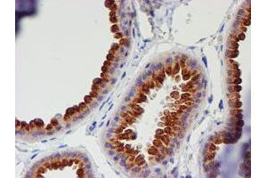 Immunohistochemical staining of paraffin-embedded Human breast tissue using anti-MEF2C mouse monoclonal antibody. (MEF2C anticorps)