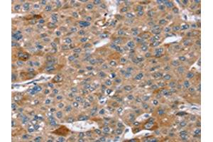 The image on the left is immunohistochemistry of paraffin-embedded Human liver cancer tissue using ABIN7192629(SPATA5L1 Antibody) at dilution 1/20, on the right is treated with synthetic peptide. (SPATA5L1 anticorps)