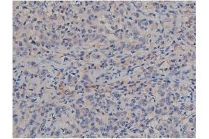 ABIN6267357 at 1/200 staining Human ganstric cancer tissue sections by IHC-P.