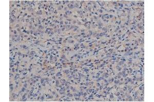 ABIN6267357 at 1/200 staining Human ganstric cancer tissue sections by IHC-P. (MAPT anticorps  (pSer422))
