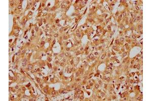 IHC image of ABIN7127584 diluted at 1:185 and staining in paraffin-embedded human liver cancer performed on a Leica BondTM system.