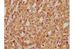 IHC image of ABIN7127584 diluted at 1:185 and staining in paraffin-embedded human liver cancer performed on a Leica BondTM system. (Recombinant ITGB1 anticorps)